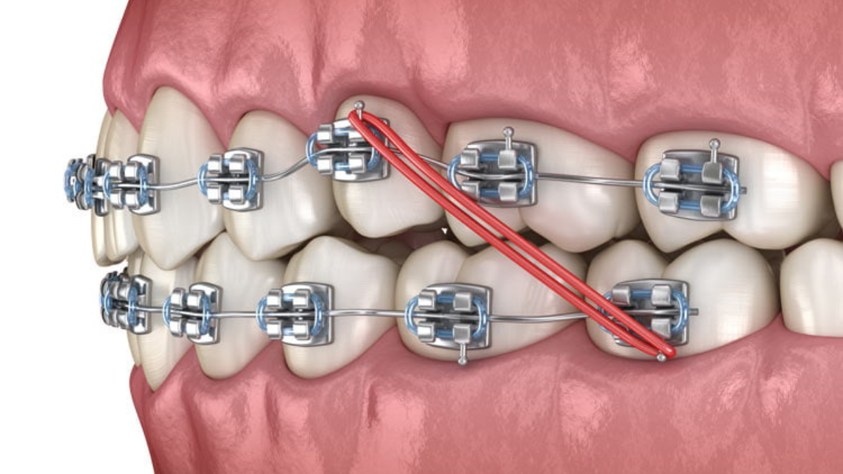 Best Dental Clinic in Pimple Saudagar for orthodontic