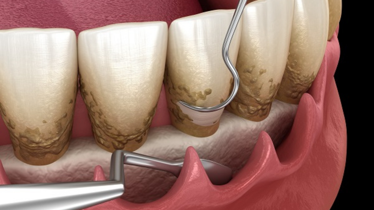 Best Dental Clinic in Pimple Saudagar for periodontics
