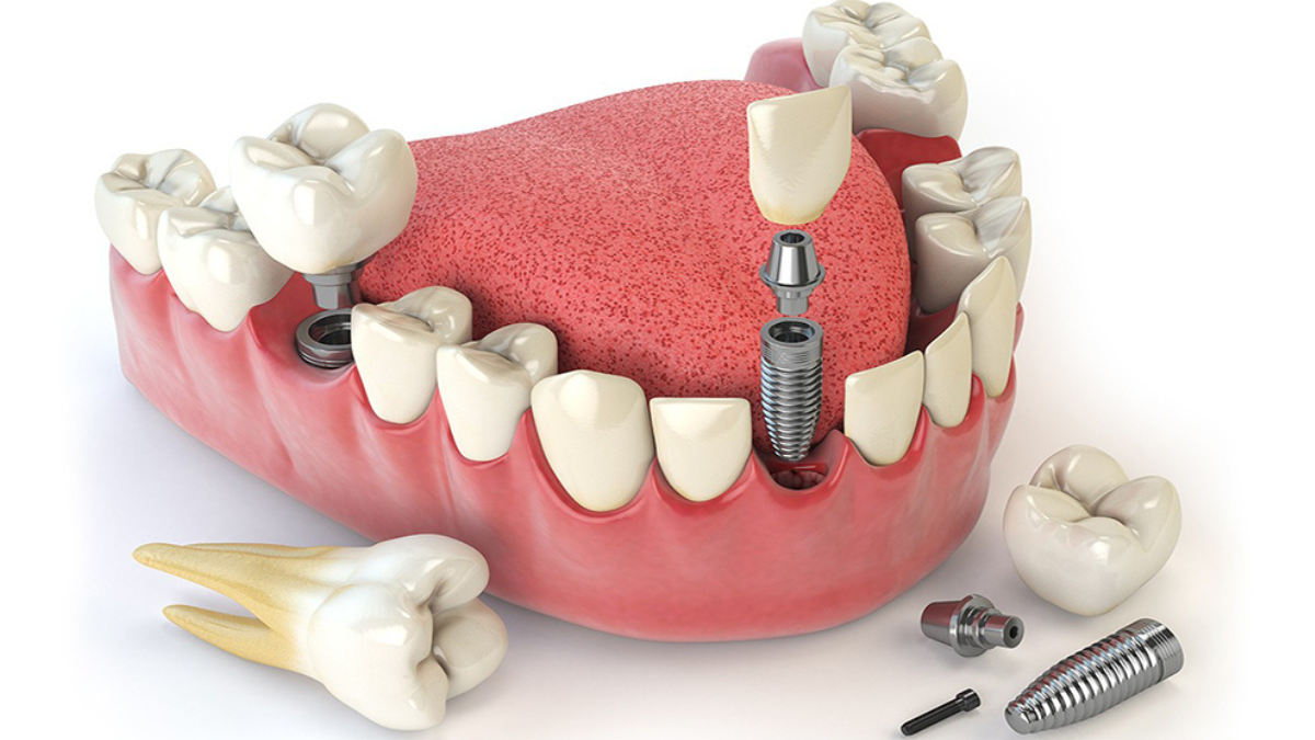 Best Dental Clinic in Pimple Saudagar