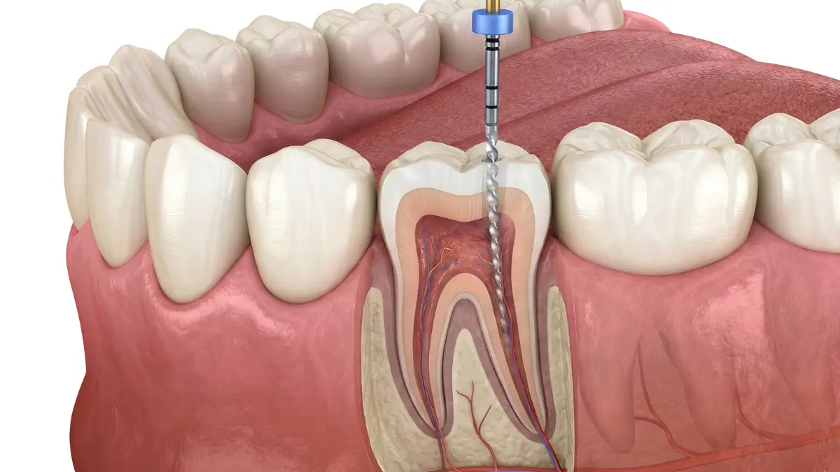 Best Dental Clinic in Pimple Saudagar  for painless root canal treatment