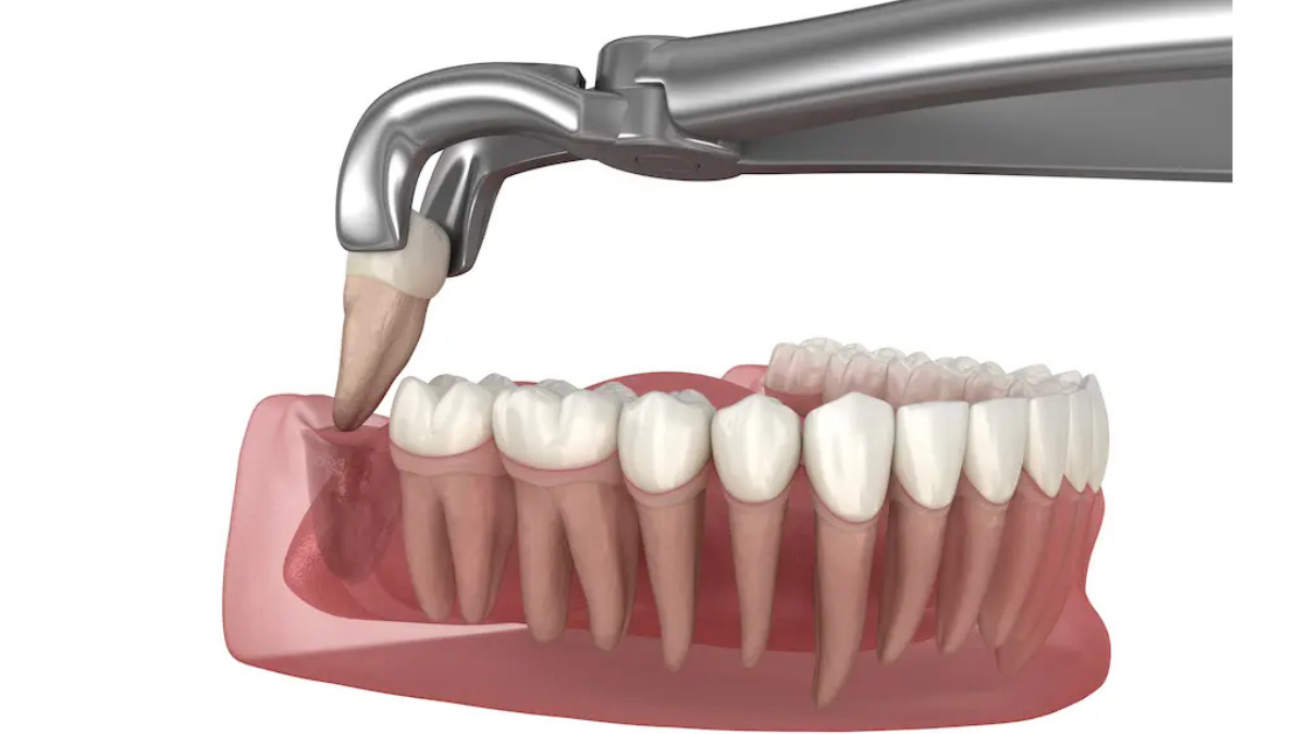 Best Dental Clinic in Pimple Saudagar